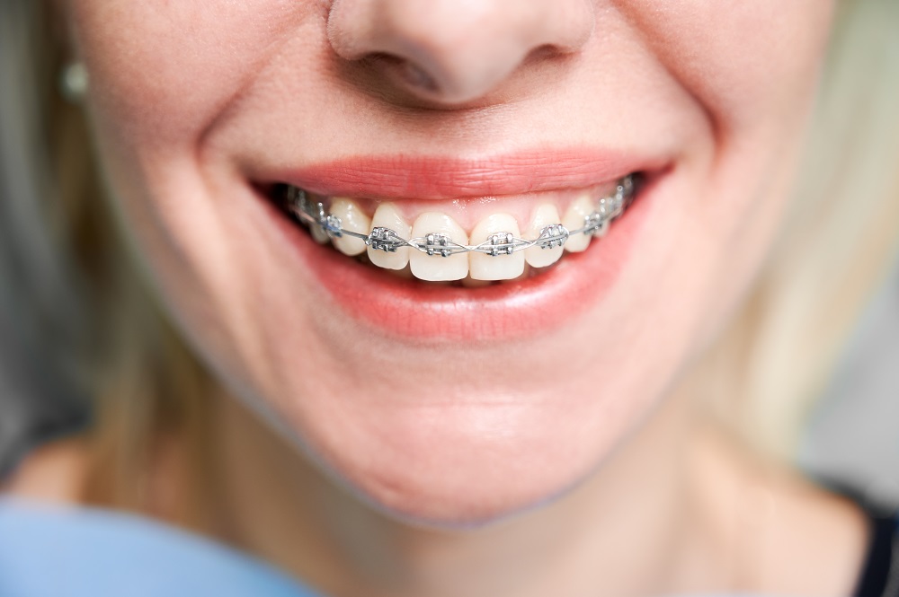 Close up of woman with charming smile demonstrating white teeth with orthodontic brackets. Female patient showing results of dental braces treatment. Concept of orthodontic treatment and dentistry.